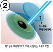 `빛번짐.눈부심' 부작용 해결 `아이라식' 선보여 - 2