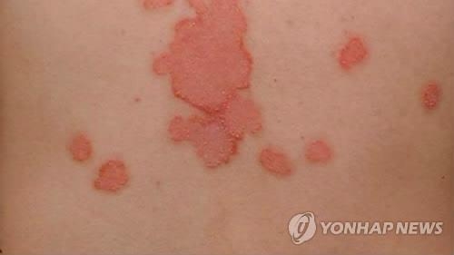 "건선, 비만·당뇨병과 관계있다" - 2