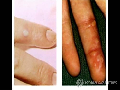 영유아 수족구병 급속 확산…환자 2주새 40% 급증 - 2