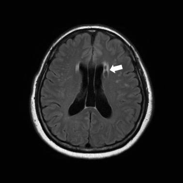 무증상 뇌경색 환자의 뇌 MRI 사진
