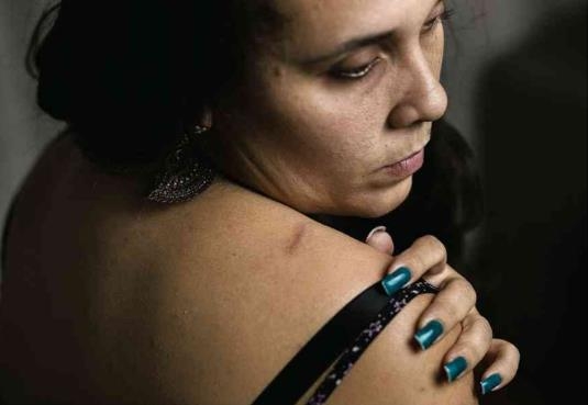 리우에 사는 한 여성이 유탄에 맞은 어깨를 가리키고 있다. 