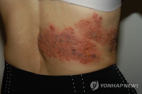 대상포진
