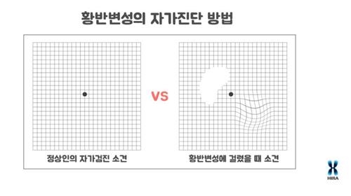황반변성 자가진단 방법.