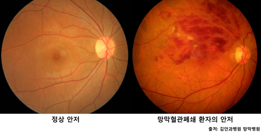 "실명 위험 '망막혈관폐쇄' 10명 중 8명 50대 이상" - 1