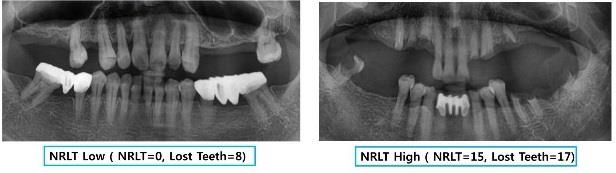 빠진 치아를 대부분 재건한 영상(왼쪽)과 재건하지 않고 방치한 영상(오른쪽)