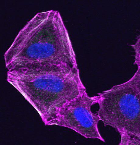 세포 골격을 바꾼 약물 저항성 흑색종 세포