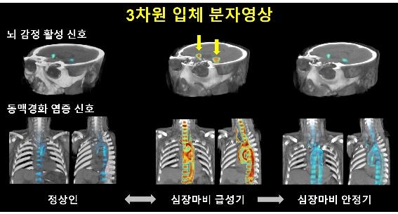 대뇌 감정영역-동맥경화성 염증활성도 삼차원 입체 분자 영상