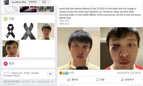 지난해 2월 폭행 직후 페이스북에 사진을 올린 조너선 목(자료사진)