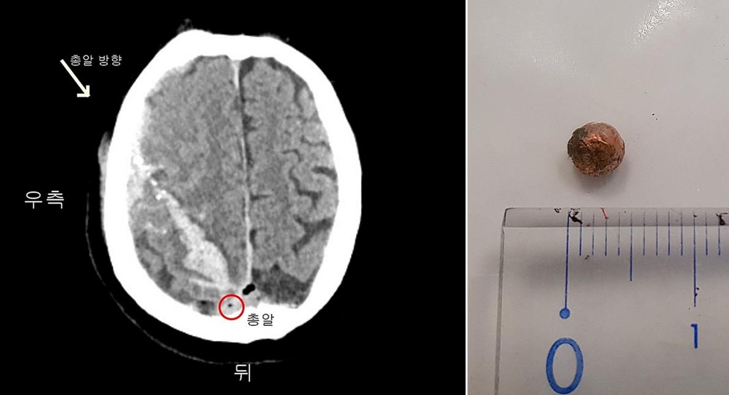 총상 환자 뇌 CT 사진과 몸에서 빼낸 총알