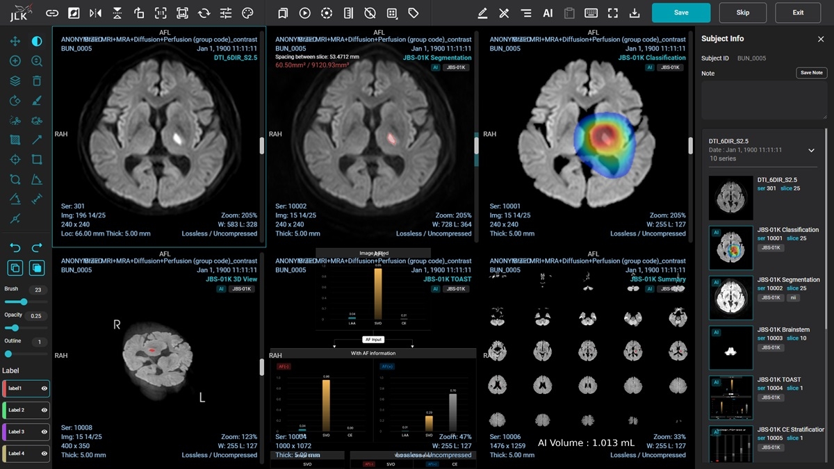 뇌경색 유형 분석 설루션 'JBS-01K'