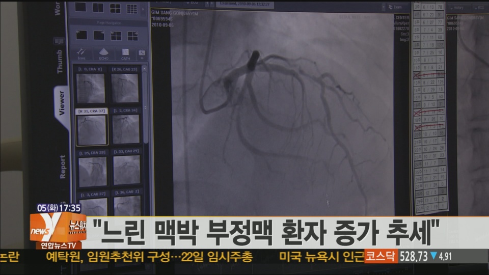 "느린 맥박 부정맥 환자 증가 추세"