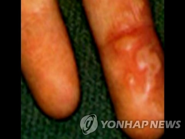 수족구병