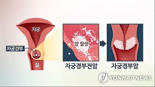 자궁경부암 (CG)