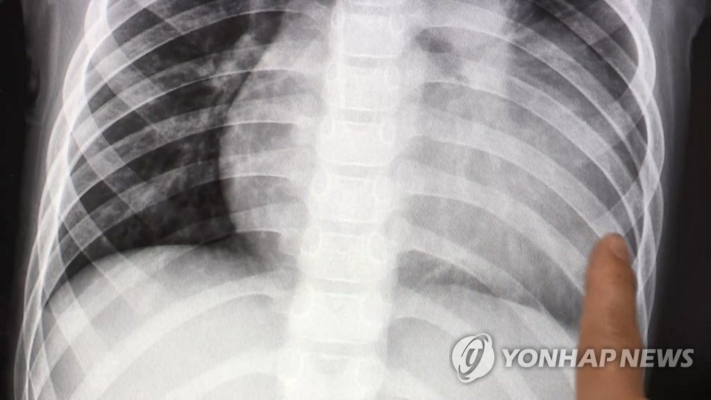 폐 엑스레이