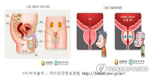 전립선비대증