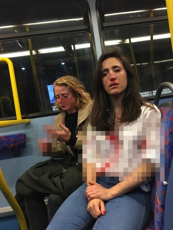 런던 레즈비언 폭행 사건의 피해자 멜라니아 헤이모나트가 공개한 피해 직후 사진