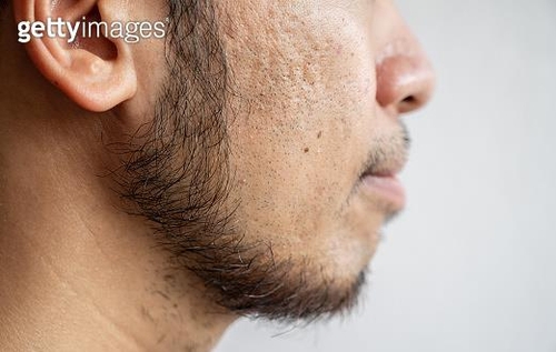 코, 입 등 얼굴 특징 결정 짓는 유전자 자리 32개 규명