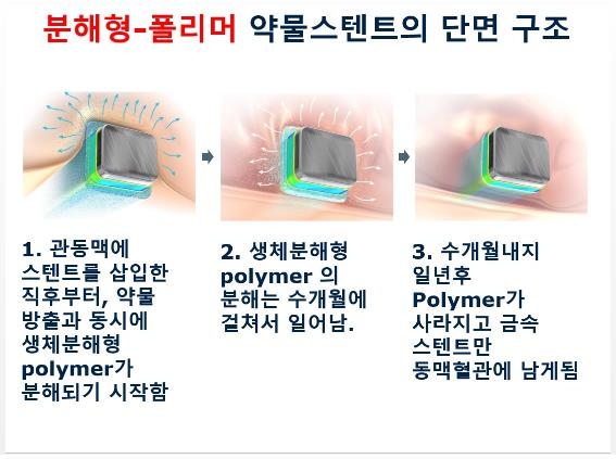 분해형-폴리머 스텐트 단면 구조