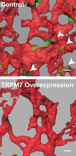 암세포와 TRPM7 단백질 