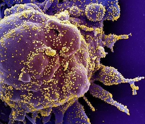 Novel corona (yellow) infected cells (purple)