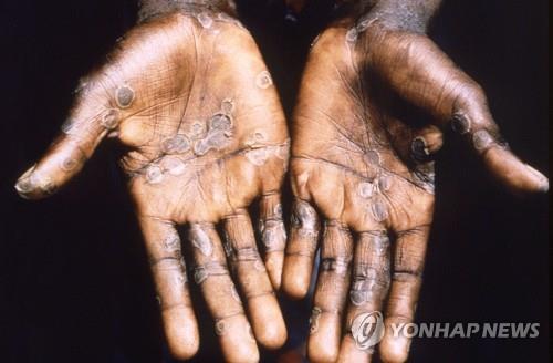 1997년 촬영한 원숭이두창 감염 환자의 손바닥