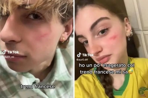 이탈리아 10대들 사이에서 유행 중인 '프렌치 흉터 챌린지'