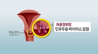 자궁경부암(CG)