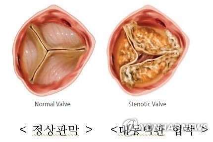 "소염진통제 세레브렉스, 대동맥 협착 위험↑"