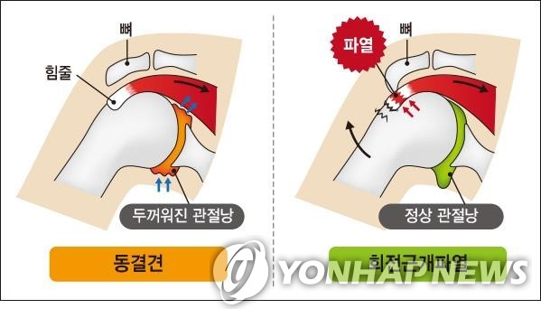 오십견과 회전근개파열