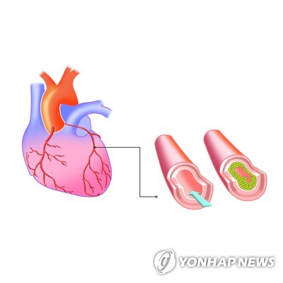 "적색·가공육 섭취, 관상동맥질환 위험↑"…140만명 추적 조사
