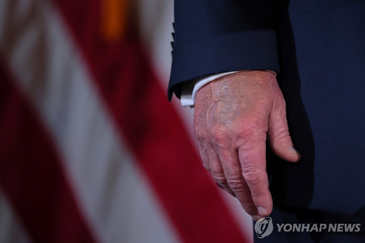트럼프, 다리 붓는 만성 정맥부전 진단…백악관 "70대…