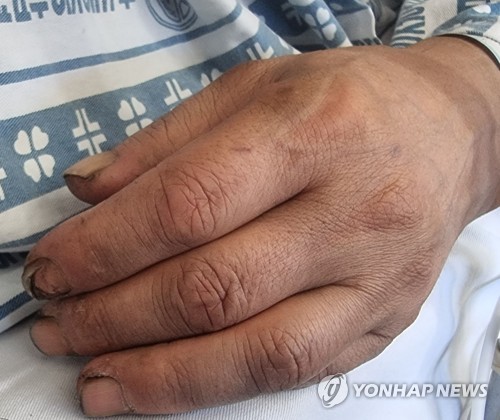 '생환' 봉화 광산 광부 박정하씨의 갈라진 손끝